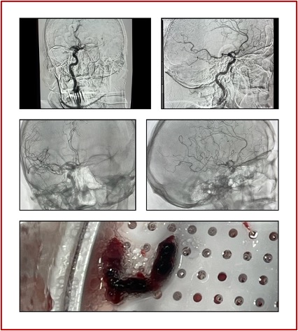 PenNeuro's tweet image. US HCPs: Dr. Paul Hansen gets TICI 3 in one pass with #RED68 in this case out of Medical City Fort Worth. #REDglideDifference Rx only. For risk info: bit.ly/37YcYIU Clinical results may vary.
