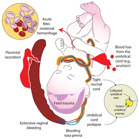 Satyan (@neosatyan) on Twitter photo #Neographic of causes of volume loss in a fetus and Role of Volume Replacement during Neonatal Resuscitation in the Delivery Room mdpi.com/1855926 #mdpichildren via <a href="/MDPIOpenAccess/">MDPI</a> by <a href="/SankaranDeepika/">Deepika Sankaran</a> and <a href="/EmilyCALane/">Emily Lane</a> and colleagues from <a href="/UCDavisChildren/">UCDavisChildrensHosp</a> #Neographic of causes of volume loss in a fetus and Role of Volume Replacement during Neonatal Resuscitation in the Delivery Room mdpi.com/1855926 #mdpichildren via <a href="/MDPIOpenAccess/">MDPI</a> by <a href="/SankaranDeepika/">Deepika Sankaran</a> and <a href="/EmilyCALane/">Emily Lane</a> and colleagues from <a href="/UCDavisChildren/">UCDavisChildrensHosp</a>