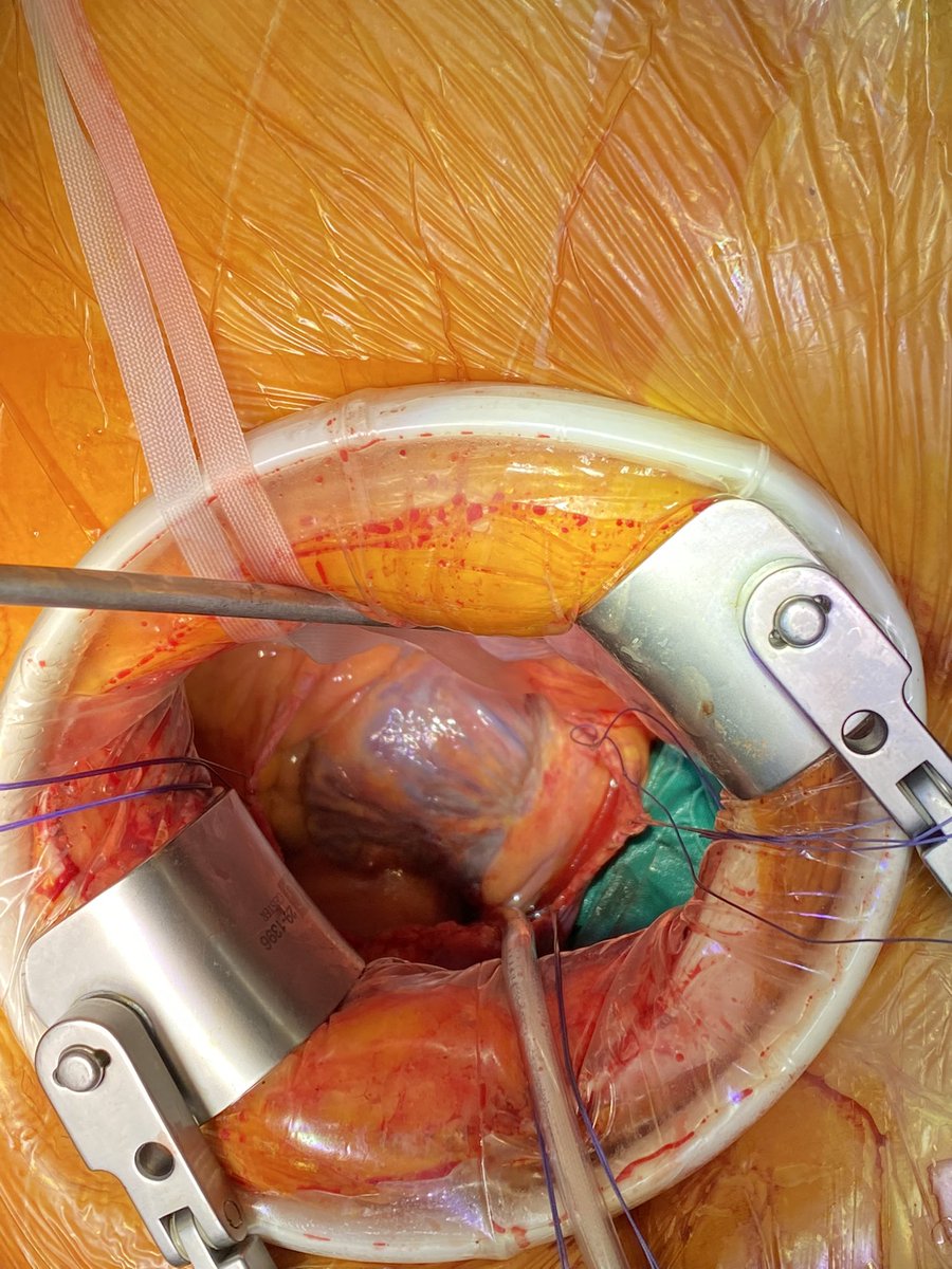 driuliaandras's tweet photo. Are there any limits for laparoscopy? Today, radical nephrectomy with level IV thrombus by combined laparoscopic and mini-thoracoscopic approach performed by @drnicolaecrisan #urology #3dlaparoscopy #nolimits https://t.co/vFYsJZtQ1W