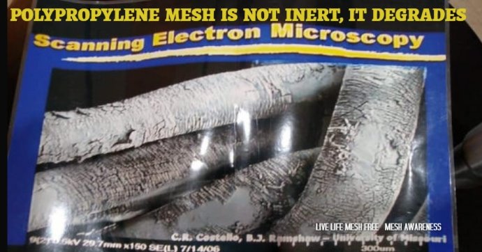 JanUrban12's tweet photo. Dr. Ramshaw provided this example from an actual removal of how polypropylene mesh degrades in the human body. And yet it continues to be used putting #patients a risk for a #Lifetime of Misery #Biofilms #ChronicInflammation #ChronicInfections #DebilitatingPain = #Diseases https://t.co/4y8JxvZDwQ