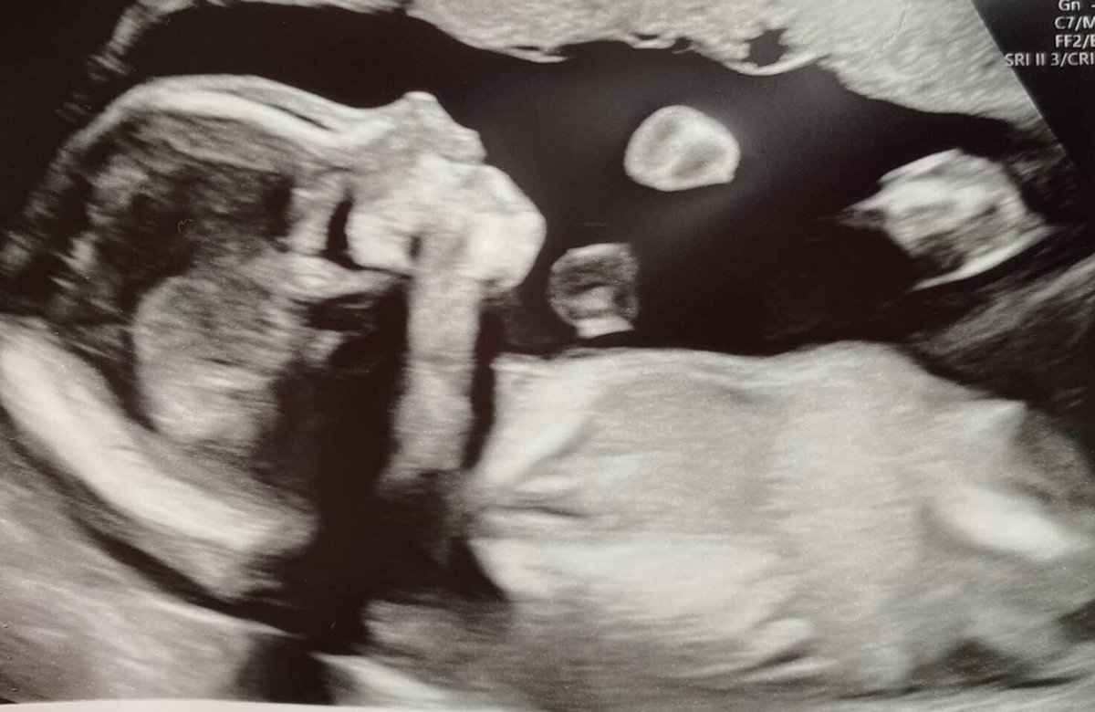 Baby Cash is growing away nicely troops 🥰 half way there, 20 weeks to go ❤️