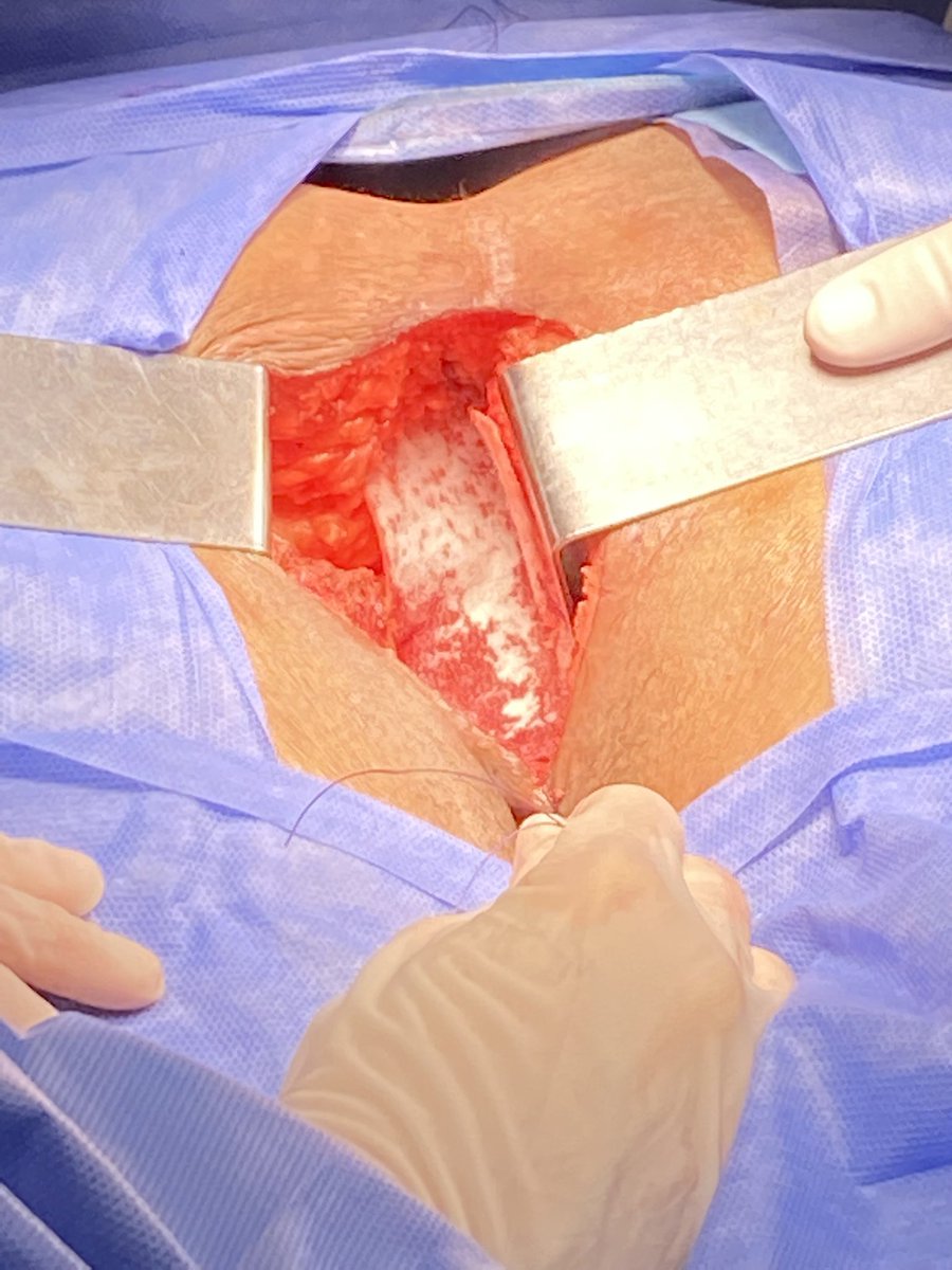 Juan C Patrón Uriburu (@jcpatron) on Twitter photo Very low LARC, w anorectal ring involvement, after CRT long course consolidation, extralevator APR. Mesh reconstruction. <a href="/sthomas2288/">Sofi Thomas</a> last week as colorectal surgeon resident <a href="/coloproctobrit/">Colorectal HB <a href="/Htal_Britanico/">Hospital Británico</a></a> @Htal_Britanico Very low LARC, w anorectal ring involvement, after CRT long course consolidation, extralevator APR. Mesh reconstruction. <a href="/sthomas2288/">Sofi Thomas</a> last week as colorectal surgeon resident <a href="/coloproctobrit/">Colorectal HB <a href="/Htal_Britanico/">Hospital Británico</a></a> @Htal_Britanico