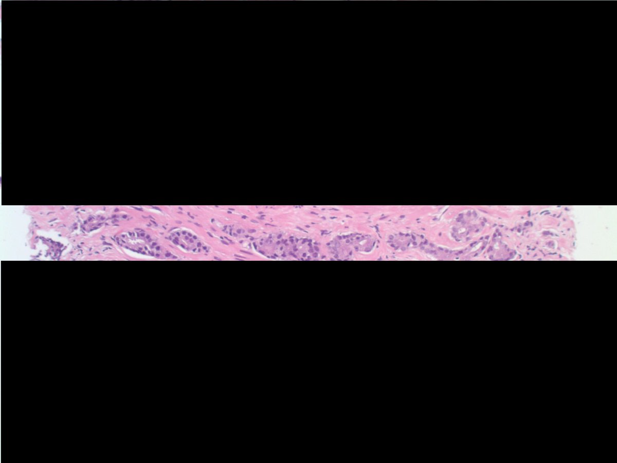 slusagar's tweet image. #PathTip #GUpath #LPpath:
when screening prostate biopsies at low power &amp;amp;👁️ small glands traversing from one side of the core to the other ("glands crossing the street), definitely🛑stop🛑 &amp;amp; go down on high power!