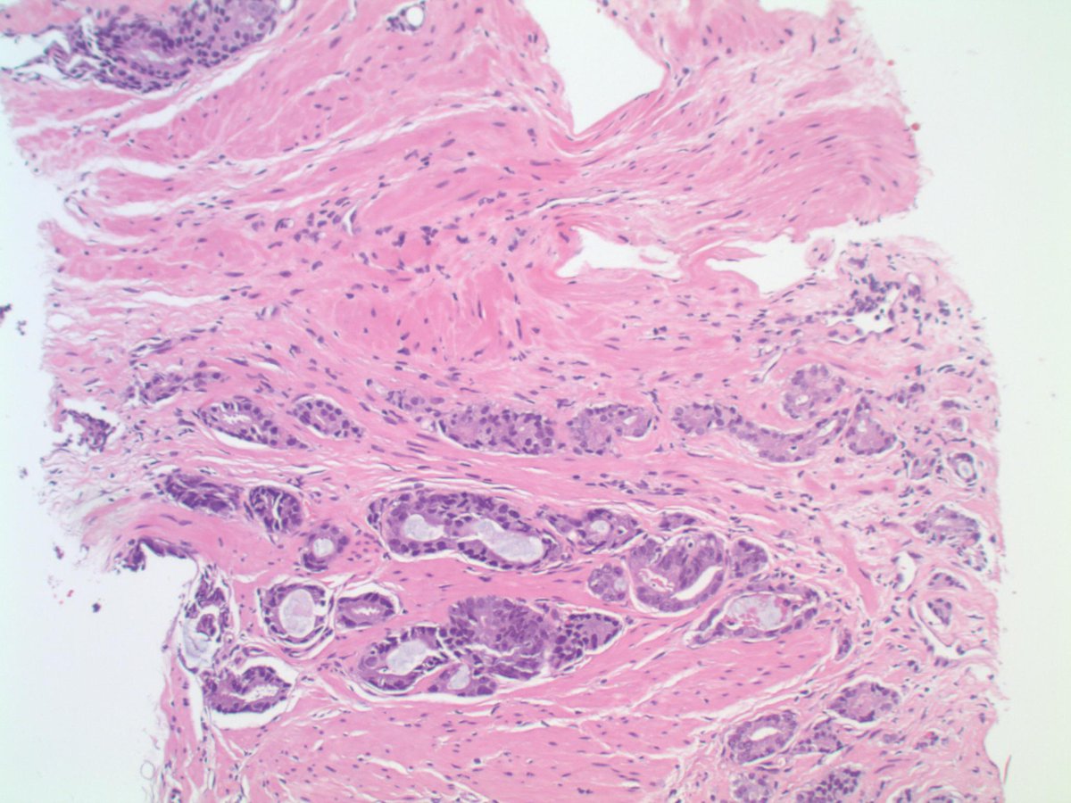 slusagar's tweet image. #PathTip #GUpath #LPpath:
when screening prostate biopsies at low power &amp;amp;👁️ small glands traversing from one side of the core to the other ("glands crossing the street), definitely🛑stop🛑 &amp;amp; go down on high power!