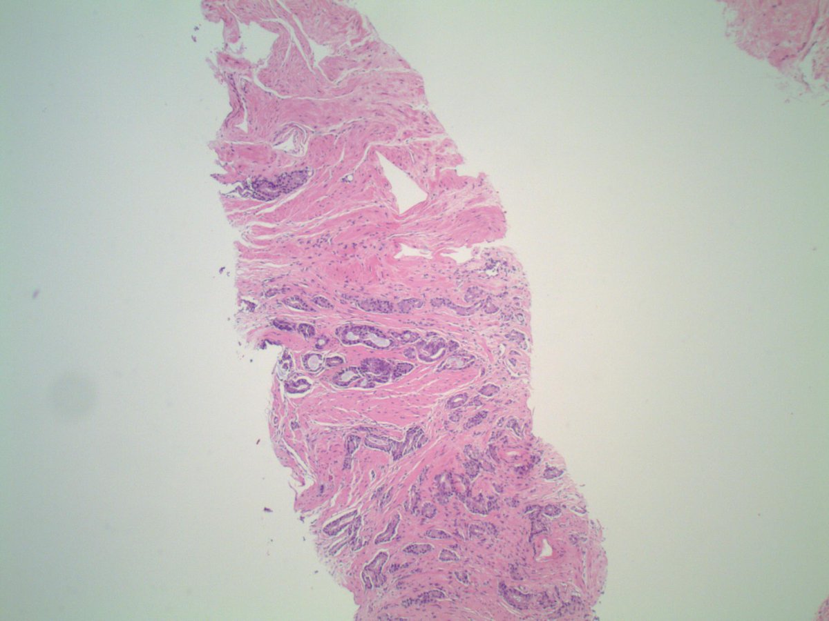 slusagar's tweet image. #PathTip #GUpath #LPpath:
when screening prostate biopsies at low power &amp;amp;👁️ small glands traversing from one side of the core to the other ("glands crossing the street), definitely🛑stop🛑 &amp;amp; go down on high power!