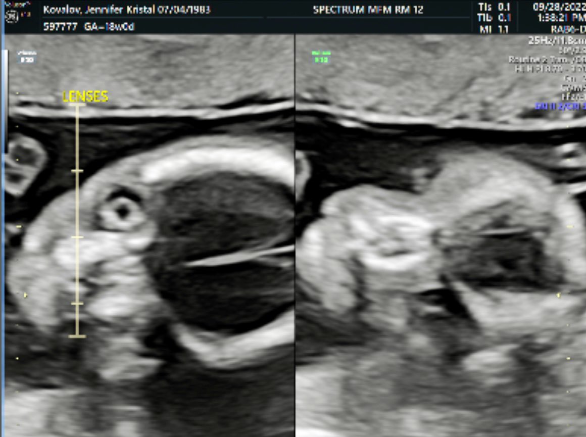 jenkovalov's tweet image. We got to see baby girl on the sonogram today! Tiana is very active and looking healthy as can be per our anatomy scan.

Mama, dada and big sister Anya can’t wait to meet you little one.

#AnatomyScan #18Weeks 💗🦍