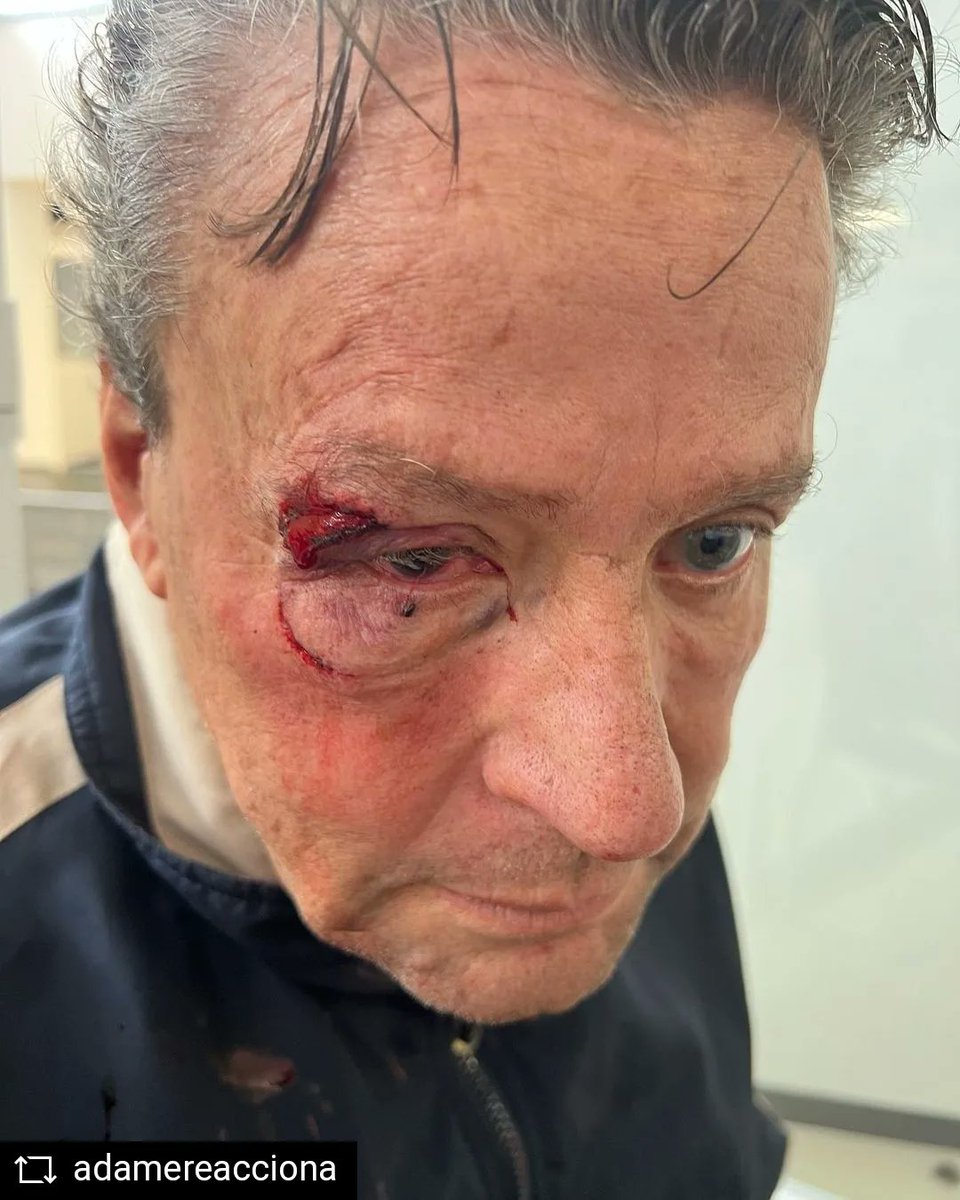LaRedCaracol's tweet photo. #LaRed / El actor #AlfredoAdames fue fuertemente golpeado.

En incidente se presentó cerca a su casa, cuando un par de facinerosos lo atacaron para robarlo. El mexicano sufrió desprendimiento de retina y se encuentra bajo observación médica. https://t.co/e2DWhB40Ki