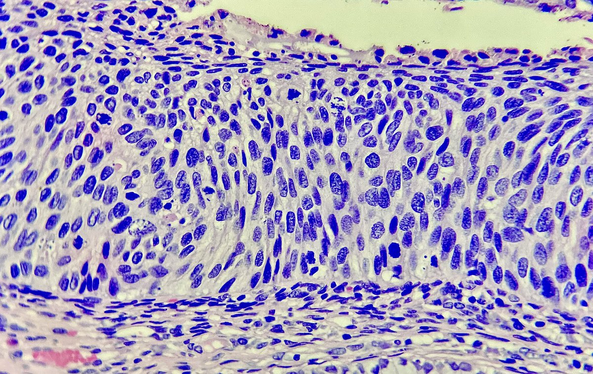 ClevesMario's tweet photo. NIC2 o NIC3?

#pathology #patologia #histologylab #histology #histologia #path #pathologists #patologos #eosina #hematoxylin #hematoxilinaeosina #pathologynotes #pathologylover #pathologyresident #pathologyresidency #pathologyresidents #gynecopath #gynecopathology https://t.co/xPoHEd0Vfn