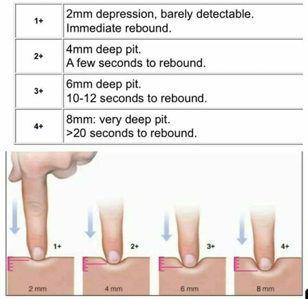 medictests's tweet photo. Pitting Edema Grading! https://t.co/ntFB86zl6j