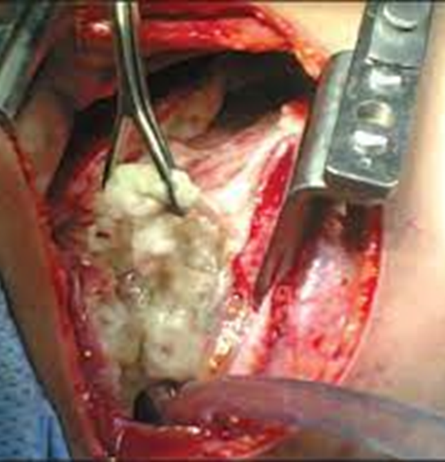 VATS or open thoracotomy can remove infected material from pleural space & decorticate visceral “rind” to facilitate re-expansion of lung when possible. Upcoming MIST-3 RCT compares the feasibility of standard care vs early IET vs early surgical referral in empyema.