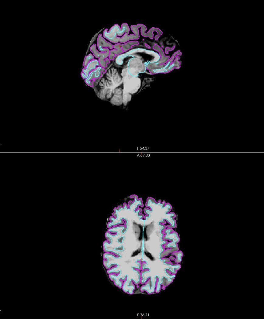 Excitement today after some pretty perfect <a href="/FreeSurferMRI/">FreeSurfer</a> recon data 🧠  Thanks Brooklyn for all your help!