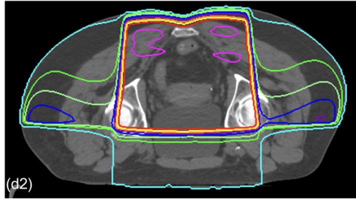 LaurenceECourt's tweet photo. Automatic treatment planning for rectal cancer - with field-in-field and wedges - Part of the Radiation Planning Assistant project to support radiotherapy planning in LMICs. @huang__kai @CarlosMedPhys @djrhee08 @MDAndersonNews .    https://t.co/nZPLVKcIcL https://t.co/uAkq0IZgBN