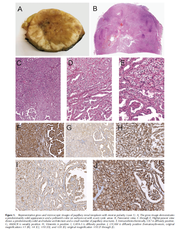 angelpanizo1's tweet image. Congratulations @LuizMiguelN  !!!! Our work has just been published. "Papillary Renal Neoplasm With Reverse Polarity. A Clinical, Pathologic, and Molecular Study of 8 Renal Tumors From a Single Institution" Arch Pathol Lab Med. 2022 Sep 28. #gupath 
pubmed.ncbi.nlm.nih.gov/36170616/