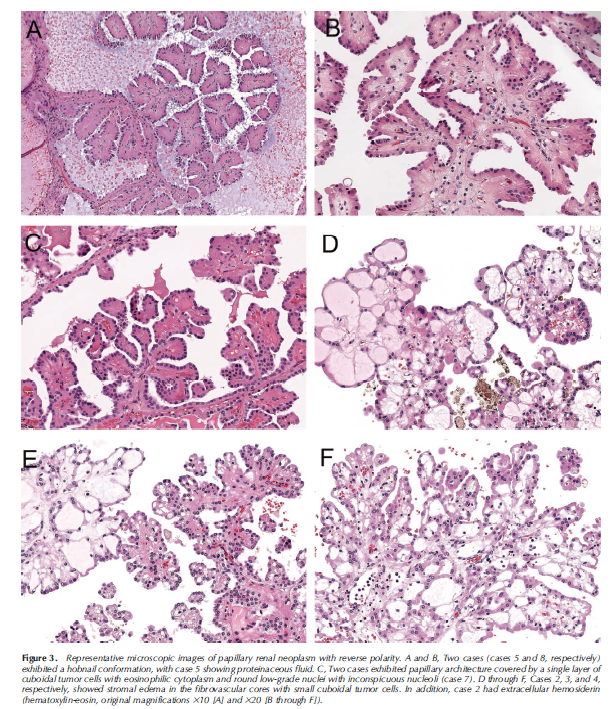 angelpanizo1's tweet image. Congratulations @LuizMiguelN  !!!! Our work has just been published. "Papillary Renal Neoplasm With Reverse Polarity. A Clinical, Pathologic, and Molecular Study of 8 Renal Tumors From a Single Institution" Arch Pathol Lab Med. 2022 Sep 28. #gupath 
pubmed.ncbi.nlm.nih.gov/36170616/