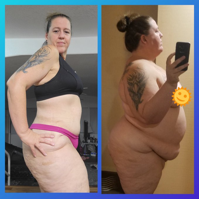 Still have a long way to go to get where I want to be but headed in the right direction. Will need some<a href="/tag/plasticsurgery"class="tags"><span>#plasticsurgery</span></a><a href="/tag/weightlosstransformation"class="tags"><span>#weightlosstransformation</span></a><a href="/tag/gastricsleeve"class="tags"><span>#gastricsleeve</span></a>