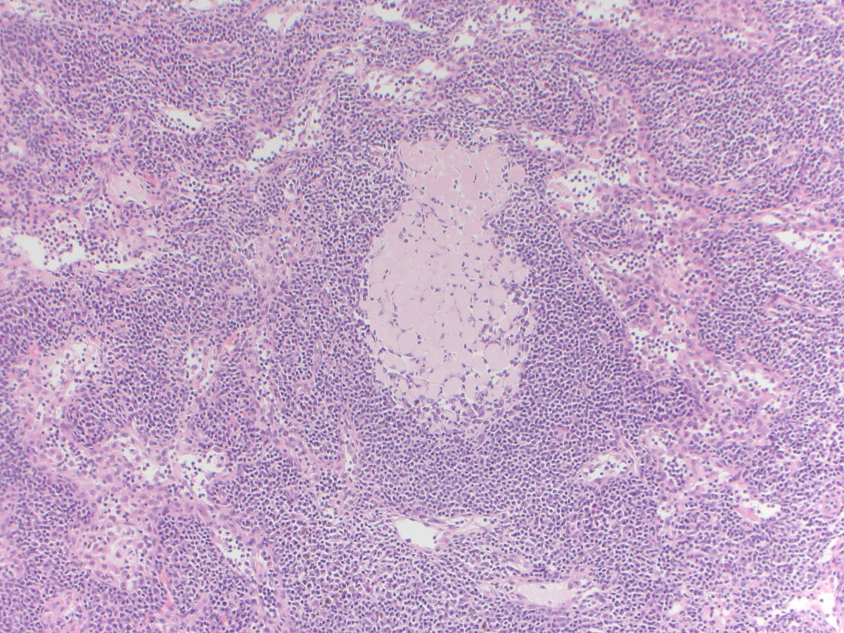 FridaRosenblum's tweet photo. Has anyone seen this in germinal centers before? @UABPathology #PathTwitter https://t.co/q0k4uXaGEt