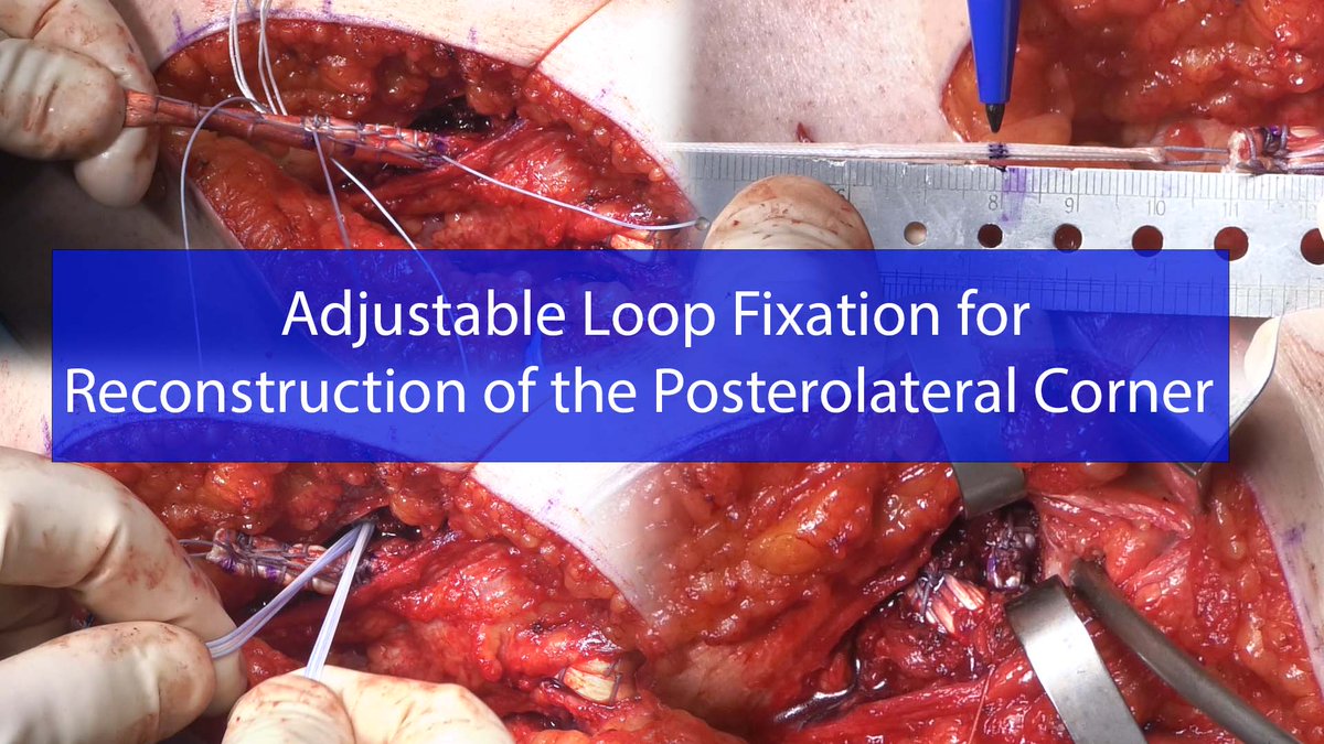 Video Journal of Sports Medicine (@videojsportsmed) on Twitter photo Having trouble with posterolateral corner #PLC reconstruction? Check out this new technique from <a href="/mayoclinicsport/">Mayo Clinic Orthopedics and Sports Medicine</a> on #VJSM using double femoral fixation! <a href="/BruceALevyMD/">Bruce A. Levy, MD</a> <a href="/MichaelStuartMD/">Michael J. Stuart</a>
Watch it here: ow.ly/kRlC50L4xU4 Having trouble with posterolateral corner #PLC reconstruction? Check out this new technique from <a href="/mayoclinicsport/">Mayo Clinic Orthopedics and Sports Medicine</a> on #VJSM using double femoral fixation! <a href="/BruceALevyMD/">Bruce A. Levy, MD</a> <a href="/MichaelStuartMD/">Michael J. Stuart</a>
Watch it here: ow.ly/kRlC50L4xU4
