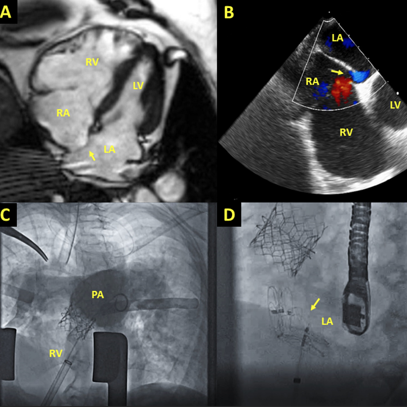 Videoclips in "PFO Closure after Pulmonary Valve Intervention in Patients with Hypoxemia Due to Right-to-Left Intracardiac Shunt" by Suhas Babu <a href="/zzbaus/">Zhihao Zhu</a> <a href="/rahulsingh921/">Rahul Singh</a> <a href="/valeriaduarteMD/">Valeria Duarte MD MPH</a> <a href="/HuieLin/">C. Huie Lin MD, PhD</a> Drs. Chavez, Li, El Nihum &amp; MacGillivray  

#DeBakeyCVJournal
doi.org/10.14797/mdcvj…