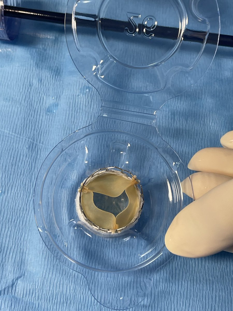 jlevismd's tweet image. Most difficult/nuanced decisions about TAVR seem to increasingly revolve around lifetime management. Great case in 65 year old bicuspid with first Sapien Ultra RESELIA TAVR in Chicagoland and my partner @mj_ricciardi first TMVR with RESILIA. Dry storage and anti-Ca## leaflets