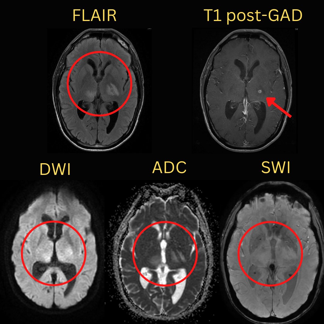 NeuroimagingN's tweet photo. CNS blastomycosis
·
Blastomyces dermatitidis

#CNSblastomycosis #blastomycesdermatitidis #blastomycosis #neuroinfectiousdiseases #neuroinflammation #neuroimmunology #neurology #neurosurgery #infectiousdiseases #neuroradiology https://t.co/JYAyMHaHbo