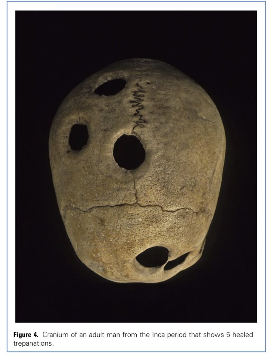 Did you know: 1,000 years ago, Inca surgeons performed craniotomies for head trauma with an estimated 80% survival rate 🤯

#MedTwitter