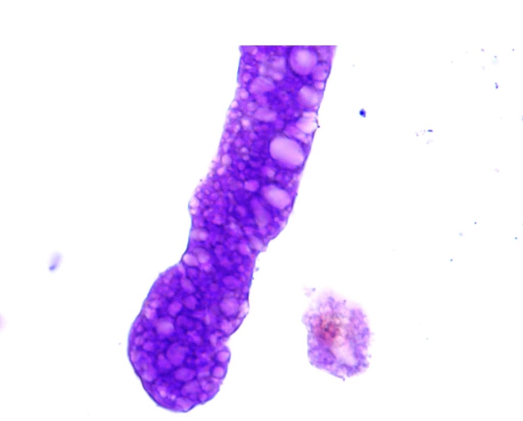 SwethaKanduriMD's tweet photo. Not an RBC cast but a giant vacuolated cast seen on urine microscopy in a pt with nephrotic proteinuria, diabetic nephropathy, UPCR 6 grams #urinesediment #nephroart ⁦@OchsnerNephro⁩ https://t.co/qGJmbGQVYR