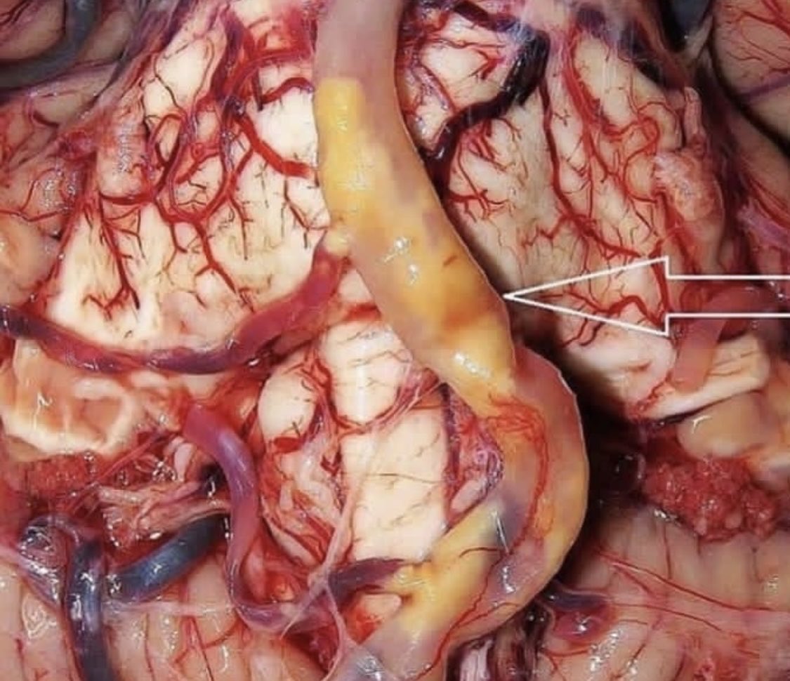 OGdukeneurosurg's tweet photo. Wow, look at that Severe atherosclerosis in the Basilar Artery. #neurology #stroke https://t.co/l6BH8gIDIn