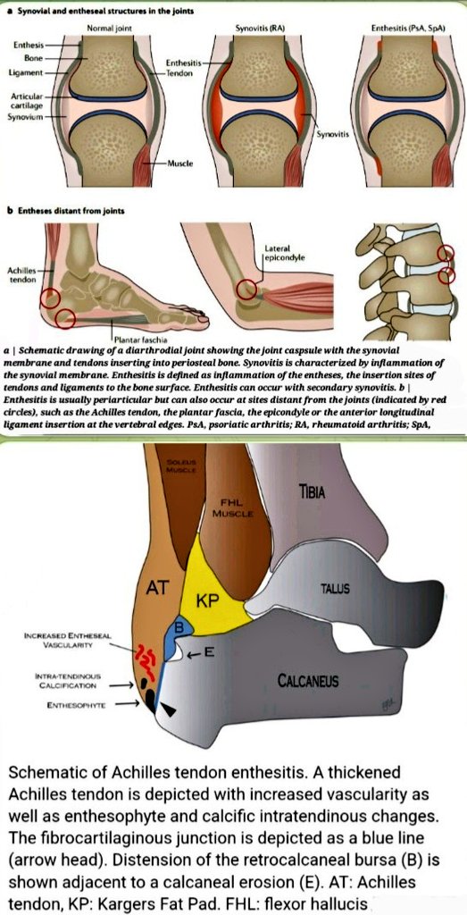 Synovitis=inflammation of synovial membrane.
Enthesitis=inflammation of entheses(insertion sites of tendons&ligaments to bone surface) nature.com/articles/nrrhe…
Enthesitis is periarticular butalso occur at the sites distant from joints(red circles)👉at Achilles tendon,plantarfascia