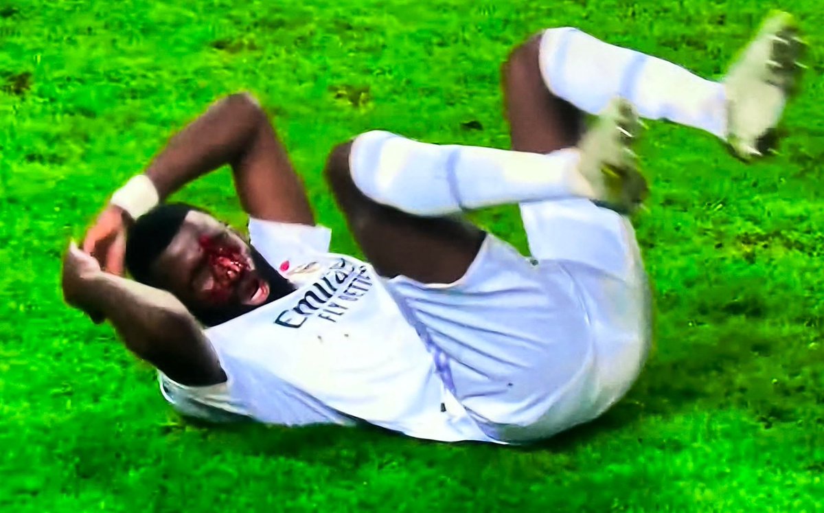 JLSanchez78's tweet photo. 🚨 RUDIGER 🚨

20 puntos de sutura (frente junto a ojo izquierdo). Mañana o pasado le harán pruebas por si hay algún tipo de fractura. https://t.co/mDGeUPso5D