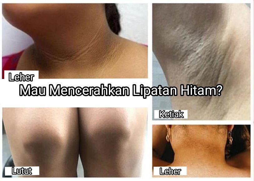 AllOfGoods's tweet photo. Treatment untuk mencerahkan lipatan yang gelap!

[ A Thread ] https://t.co/uE44ZERIoB