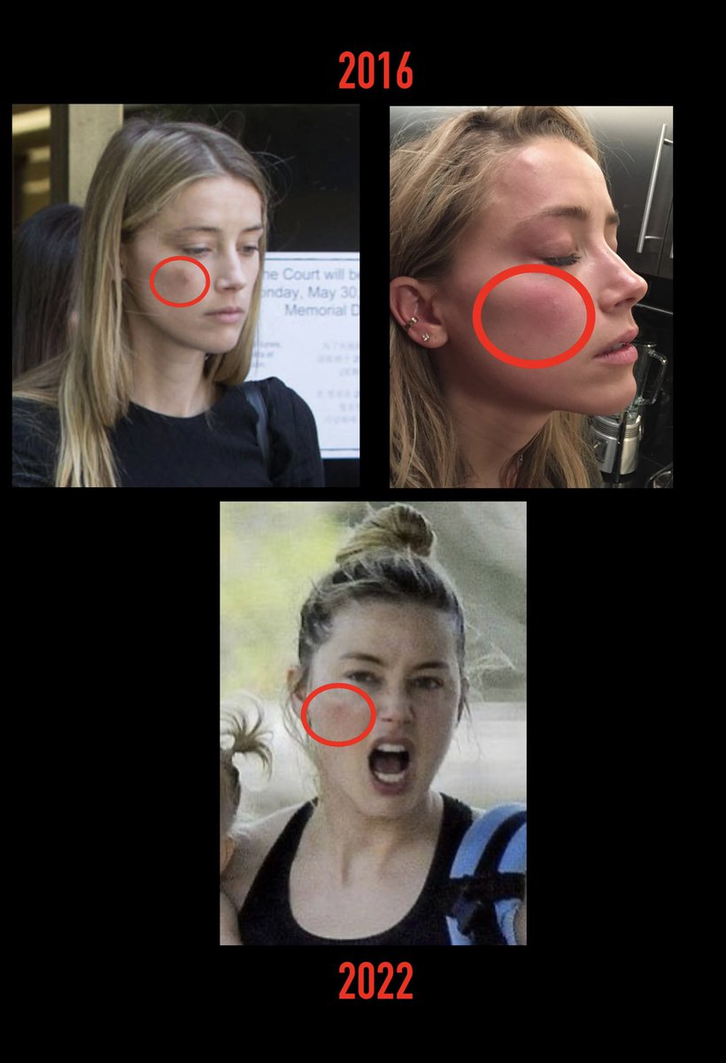 Interesting…
Same side of the face in the same spot 6 years apart. 
Makes you wonder 💭 
#AmberHeardlsALiar #AmberHeardCommittedPerjury #JohnnyDeppDeservesAnApology #JohnnyDeppWon