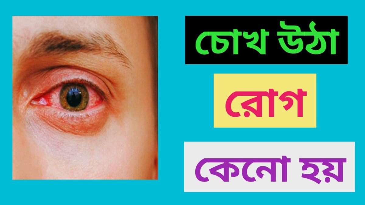 HealthSheba's tweet photo. আমাদের চোখের মধ্যে কনজাংটিভা নামের একটা আরবন রয়েছে।এই আবরন কোনও কারণে ভাইরাসে আক্রান্ত হলে চোখে প্রদাহ সৃষ্টি হয়।এরফলে চোখ লাল হতে শুরু করে।

পুরো পোস্টটি পড়তে ভিজিট করুন নিচের লিংকেঃ       

https://t.co/gKxlCQdeB4 https://t.co/iQnnDwsaRf