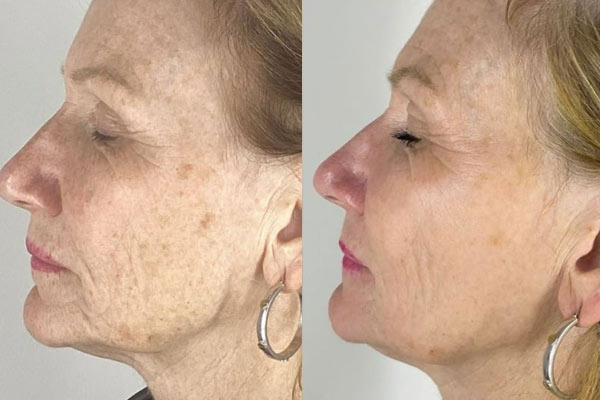 Medicetics's tweet image. If you're looking for an effective treatment to reduce the appearance of dark spots, then the Cosmelan Depigmentation Peel could be the treatment for you! 

medicetics.com/pages/cosmelan… 

#pigmentation #skincare #aesthetics
