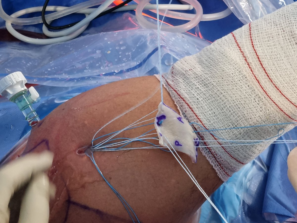 Reconstrucción Capsular Superior 
Orden y sistemática con los hilos
Cirugía reglada: "paso a paso" Trabajo en equipo
#RoturasMasivasIrreparables
#ServicioCOTDrSanchezAlepuz 
#UnidadHombro