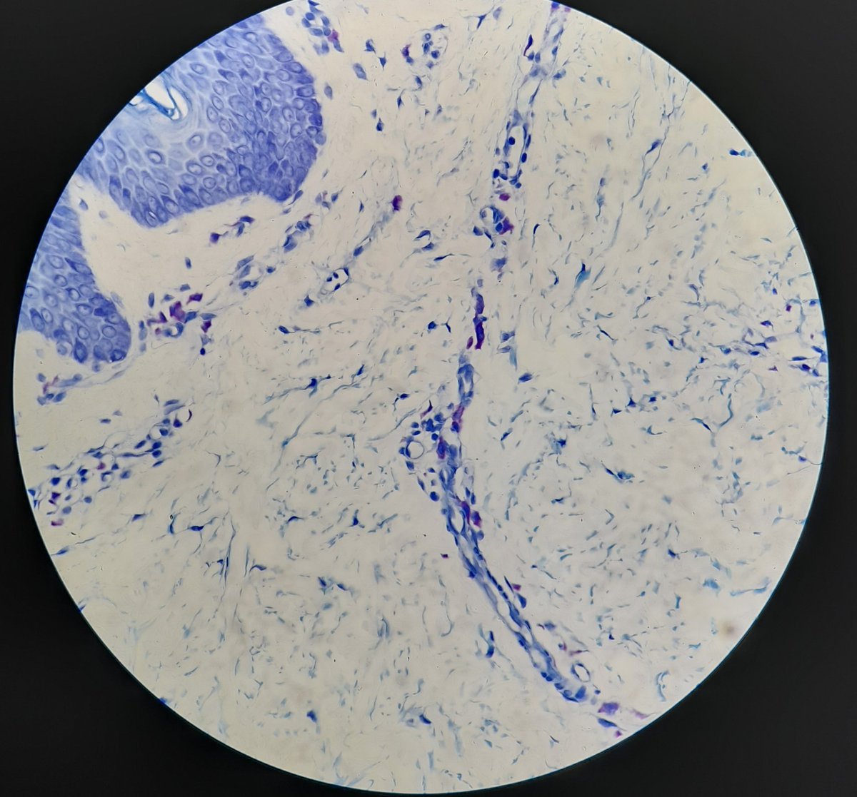 When Toluidine Blue comes to your rescue and seeks out the mast cells!
#urticaria #dermpath