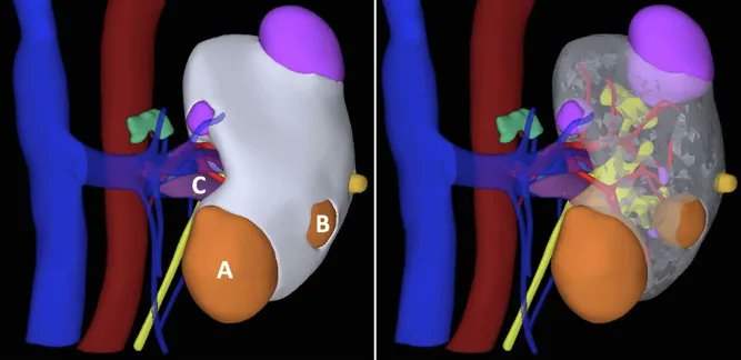 EurUrolOpen's tweet photo. Surgery in Motion: Robotic Partial Nephrectomy with En Bloc Removal of a Renal Vein Thrombus for Multiple cT3a Renal Cell Carcinoma Lesions 

https://t.co/auuvTG967U 

@GrossoAnton @fabrizio_maida @LucaLambertin12 @andreamari08 @minerviniandre 

#surgery #openscience #openaccess https://t.co/XGjff0f9R0