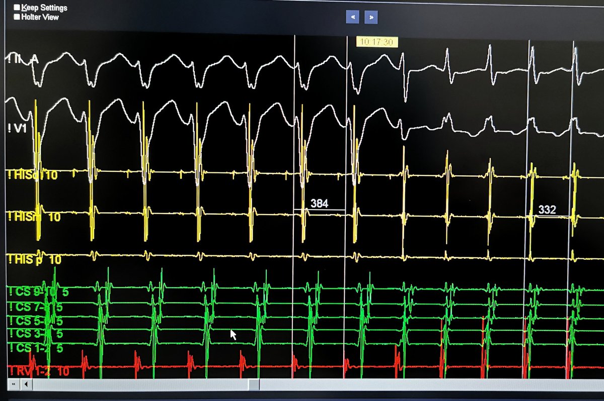 For #ePeeps in training. What is the most likely mechanism of this tachycardia? Poll in the comment🤓 #CardioTwitter #cardiology #electrophysiology #ecg #quiz