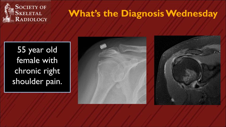 SSR_RWG (@ssr_rwg) on Twitter photo We have another interesting case this week brought to us by <a href="/paulwojackmd/">Paul Wojack</a>. Let us know what you think the diagnosis is and which anatomic structure is being affected! #mskrad #radres We have another interesting case this week brought to us by <a href="/paulwojackmd/">Paul Wojack</a>. Let us know what you think the diagnosis is and which anatomic structure is being affected! #mskrad #radres