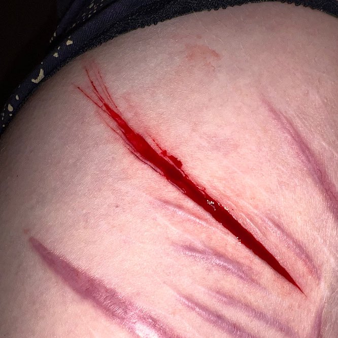 redblve's tweet photo. painted wound, not real! 🎨 all fake blood. if I don’t pull the skin back you can’t even see it :( this is a bad location :(((

styrotwt sliceytwt ouchietwt #自傷 barcodetwt strawberryfillingtwt cuttwt 988twt scartwt https://t.co/kNNQqFGtib