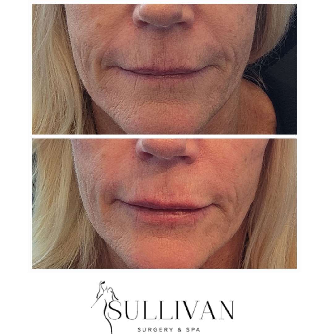 Sullivan1K's tweet photo. Aggravated with fine lines around the lips?

Small amounts of filler in these fine lines can soften the appearance and rehydrate to give a more youthful essence. 

Add a tiny bit to the lips for a plumped hydrated look.

Call today to schedule a free consult with our expert nurse https://t.co/UOqMg3SG7E