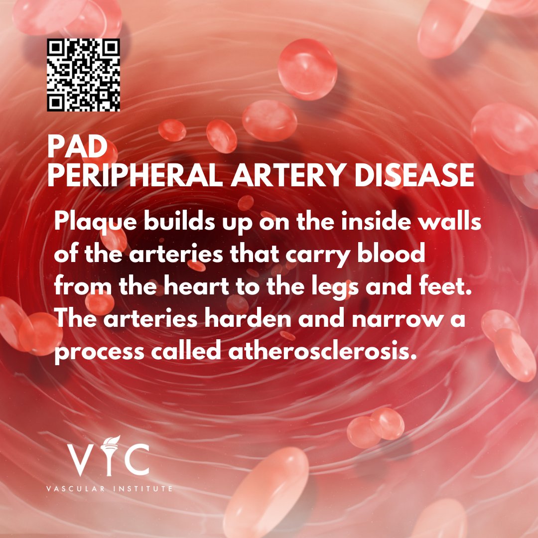 Did you know PAD affects more than 21 million Americans?
#VICOctober #VIC #VICVascular #Veins #Endovascular #ArteryDisease #FLOW #VascularSurgery #VaricoseVeins #PAD #CAS #RAS #Aneurysm #Arterial #CLI #CLIFighter #Carotid #Peripheral #Renal #Atherosclerosis #Plaque