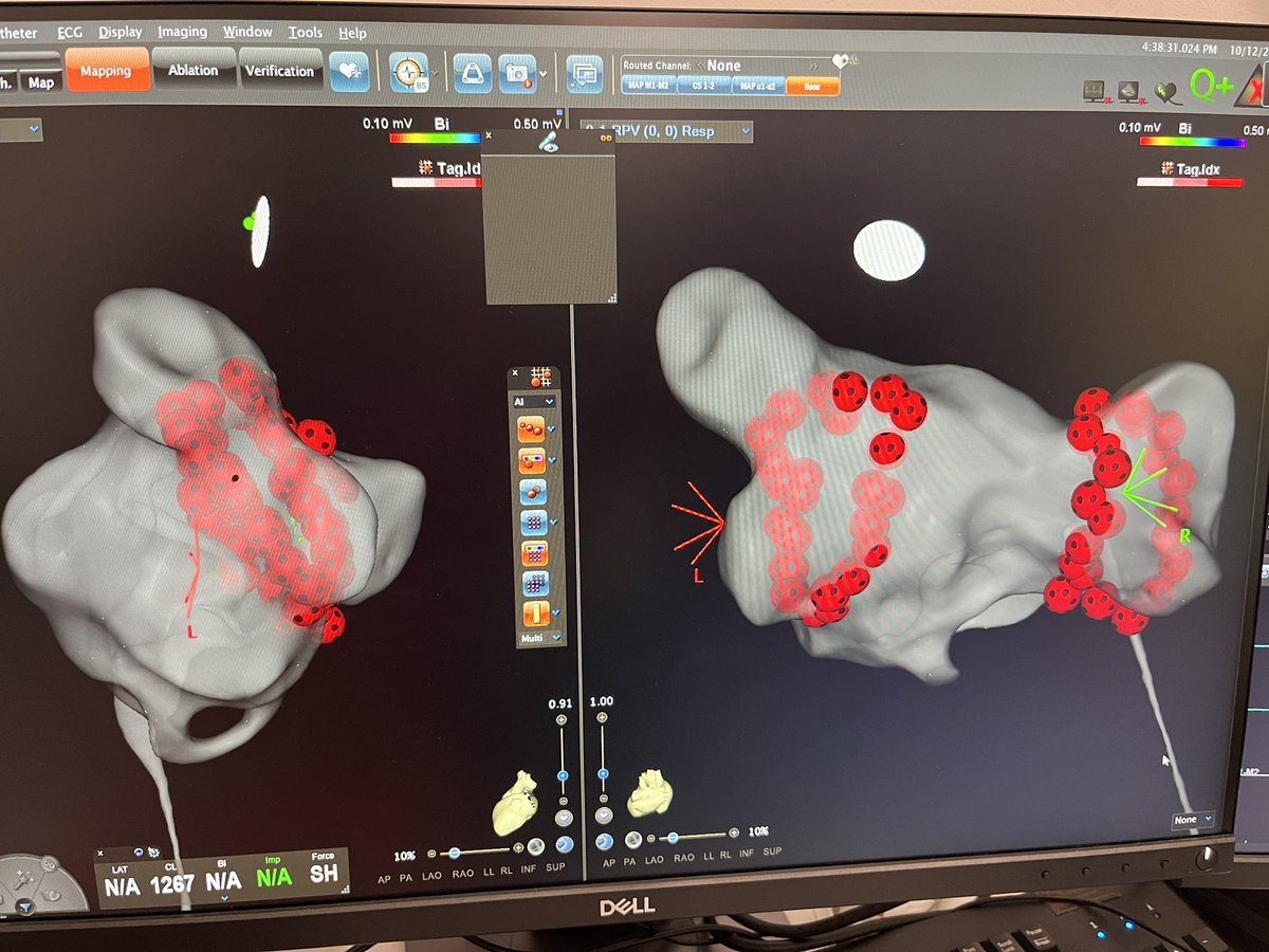 drashnisbet's tweet photo. After a very inspiring session at #HRC2022 yesterday I had the privilege to perform the first #HPSD AF ablation @BHIBristol today using #qdot. Mind blowing how quick and well tolerated it was. First pass isolation of both PV pairs in under 3 mins of RF time! Great team effort 🙌 https://t.co/epziSMJqwY