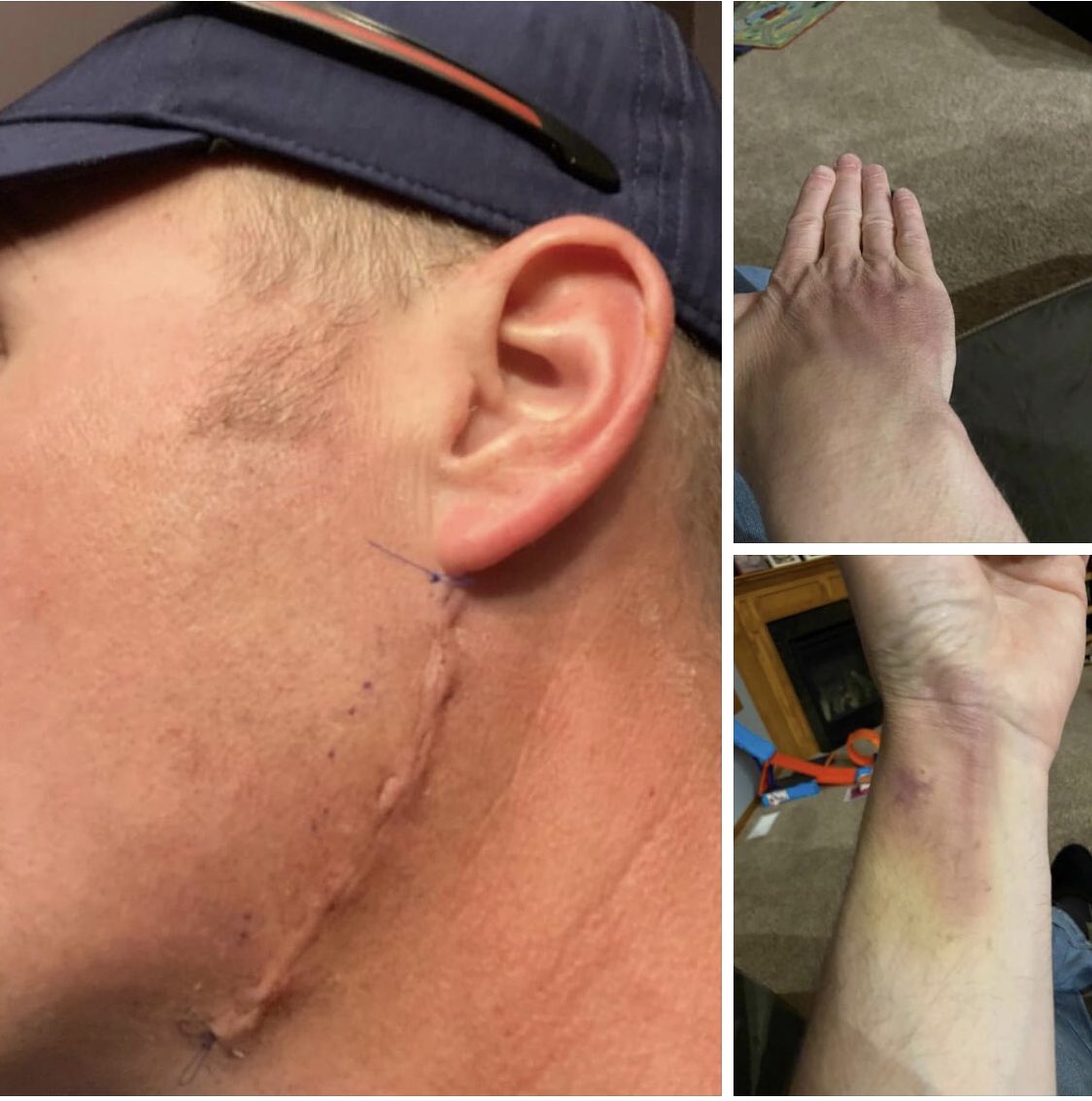 RossScreenprint's tweet photo. @kmaclean5 It’s a good spot to enter the neck to avoid a facial nerve that is tough as it goes along the chin. However, everyone responded with their scar phots to show the correct way. this is someone’s example of how it’s done in the States that deal with the CCI / EDS patients. https://t.co/Y57tx4irUY