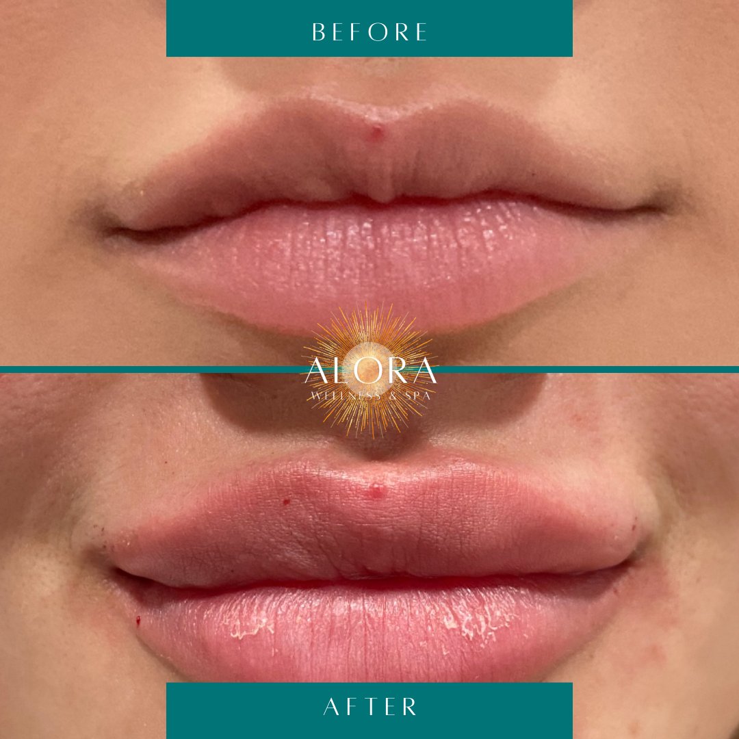 AloraWellnesSpa's tweet photo. Lucious lip transformations recently done by Cosmetic Master Injector, Sabrina! 💋💋💋

Which one is your favorite? 😍

#oregonlipfiller #lipfiller #oregonmedspa #eugenemedspa https://t.co/pbLykxV013