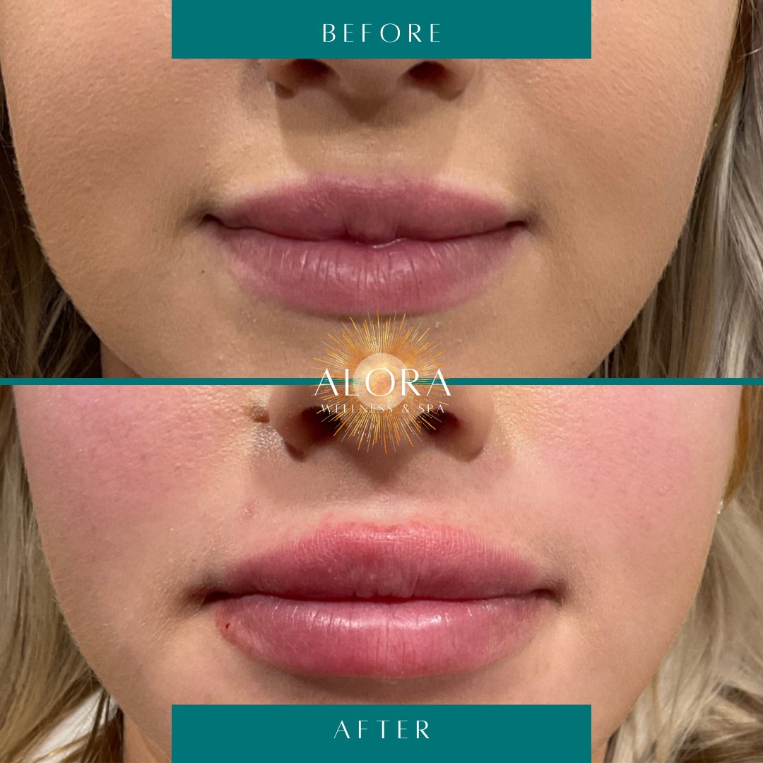 AloraWellnesSpa's tweet photo. Lucious lip transformations recently done by Cosmetic Master Injector, Sabrina! 💋💋💋

Which one is your favorite? 😍

#oregonlipfiller #lipfiller #oregonmedspa #eugenemedspa https://t.co/pbLykxV013