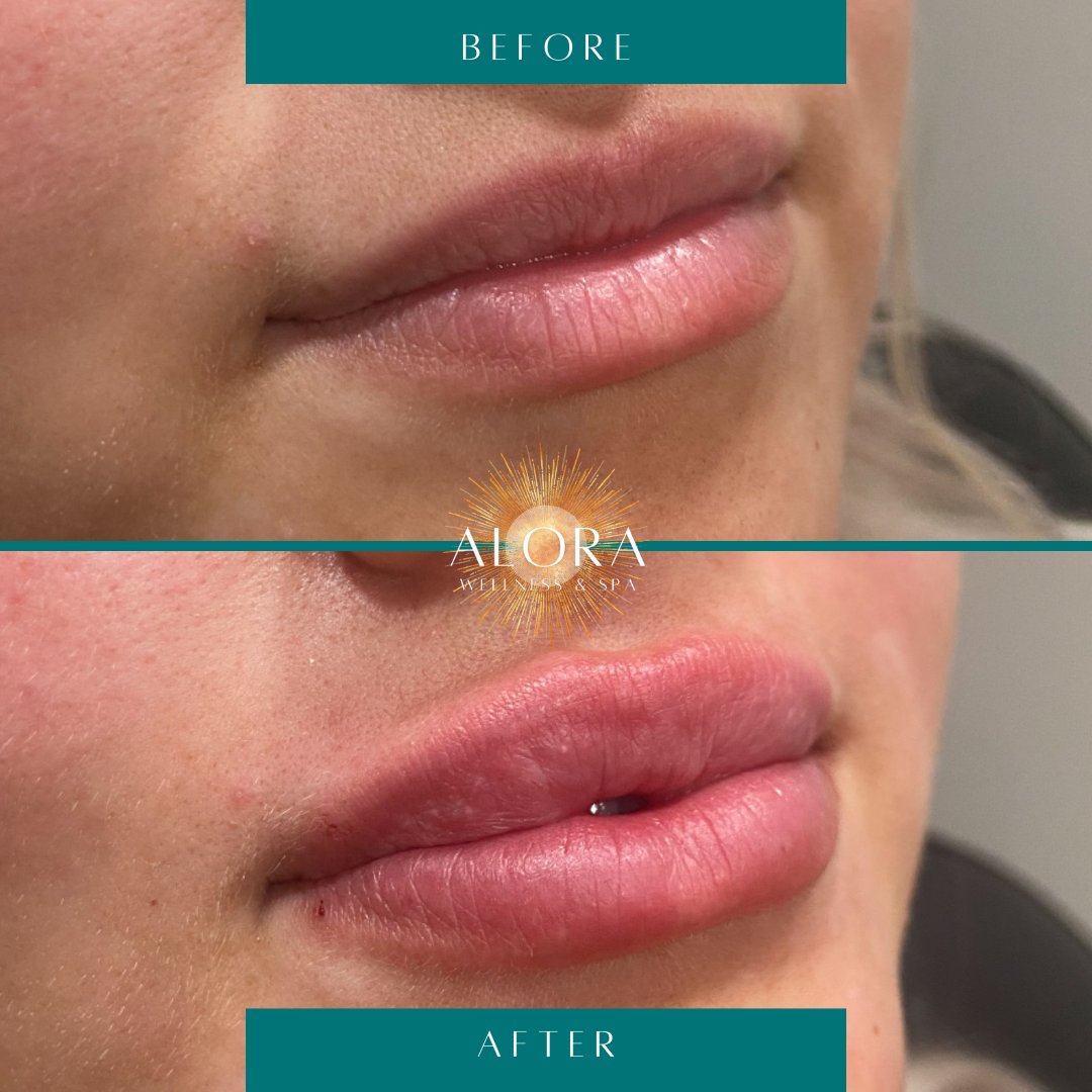 AloraWellnesSpa's tweet photo. Lucious lip transformations recently done by Cosmetic Master Injector, Sabrina! 💋💋💋

Which one is your favorite? 😍

#oregonlipfiller #lipfiller #oregonmedspa #eugenemedspa https://t.co/pbLykxV013