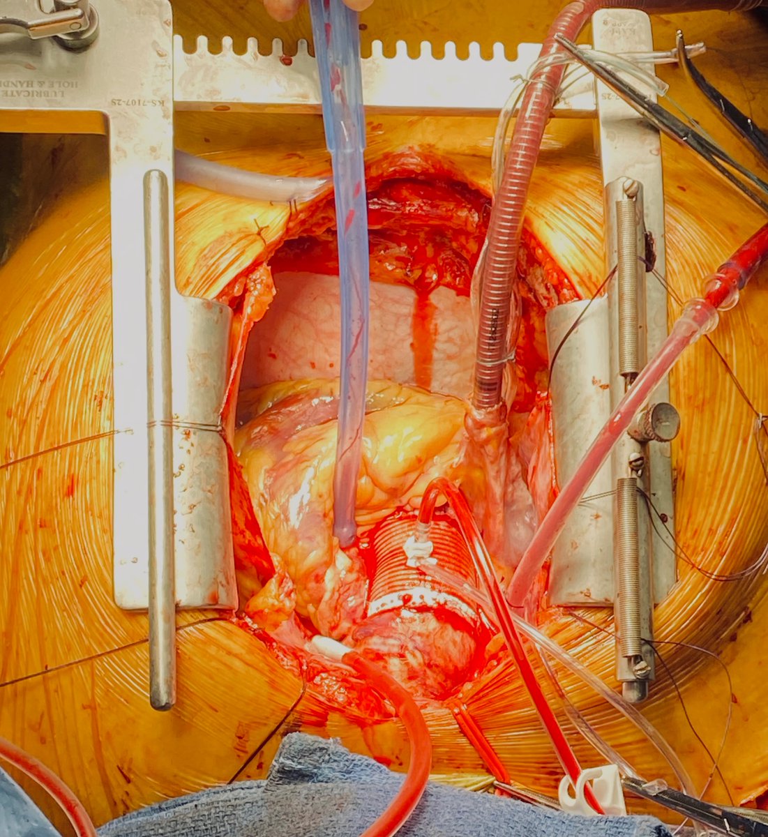 DrBrianSolomon's tweet image. 5.3 cm ascending aneurysm with bicuspid aortic valve and mod AI. Ascending replacement, 27 inspiris AVR, CABG, ablation. Replaced AV instead of repair due to heavy single leaflet calcification @NCH_Heart @RCubedduMD @PU84 @malbag1  @GCudemusMD @LoriKat7 #Cardiotwitter #aorta