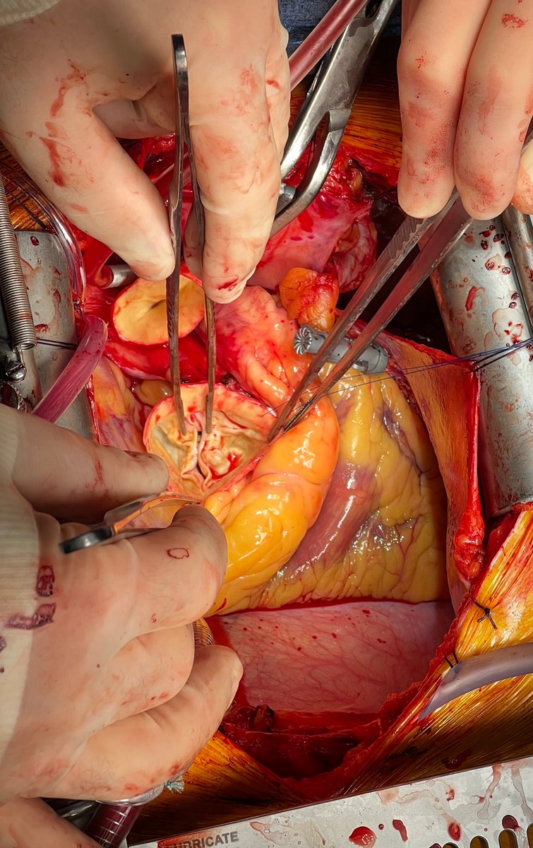 DrBrianSolomon's tweet image. 5.3 cm ascending aneurysm with bicuspid aortic valve and mod AI. Ascending replacement, 27 inspiris AVR, CABG, ablation. Replaced AV instead of repair due to heavy single leaflet calcification @NCH_Heart @RCubedduMD @PU84 @malbag1  @GCudemusMD @LoriKat7 #Cardiotwitter #aorta