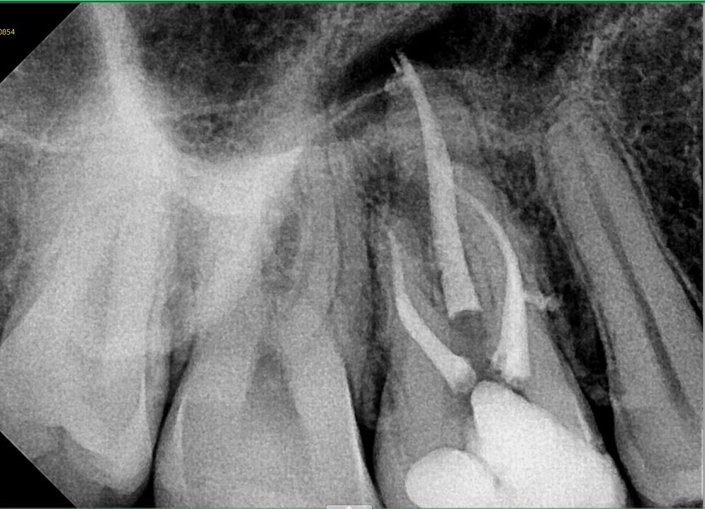 16# 
Re RCT 
Missing mb2 , mb3 
Mb2 joints to mb1 
Look at these beautiful lateral canals 
وصراحةً 
اجمل شي لما يكون طبيب اسنان هو البيشنت ، تاخذ راحتك وتاخذ وقتك كله ، ما يحتاج شرح ولا شي .