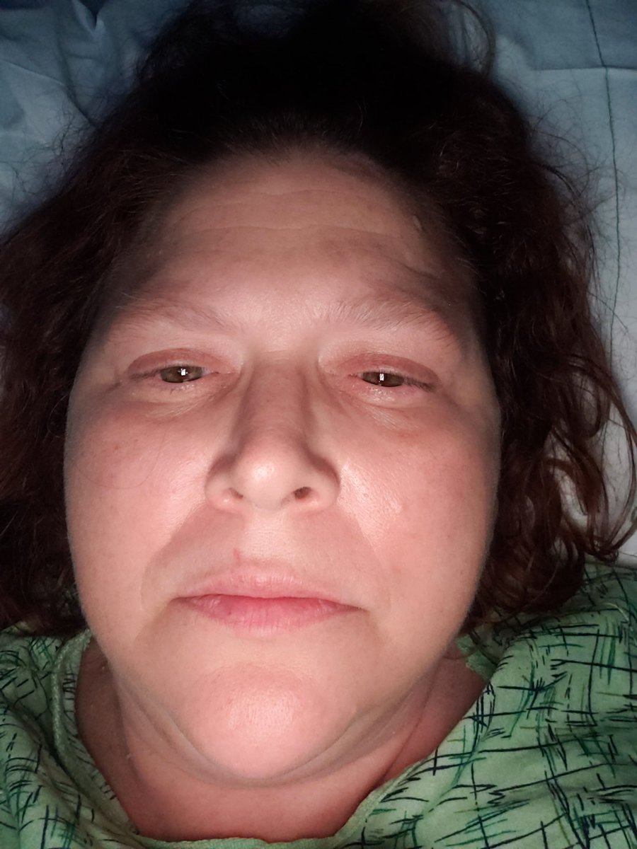 Kcbrooks76Kelly's tweet photo. @hoaghealth had to retweet u this stuff because the swelling is causing confusion &amp; Dr. Hoppe cant see swelling &amp; let me know ur can treat broken bones but can't diagnose. How are u ranked 4 in la and 9 in Ca if you cant diagnose or help people maybe USNews health needs an update https://t.co/SAKjvDlhVM